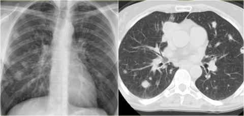 Рентгенологическая оценка лёгких: норма - Рисунок3
