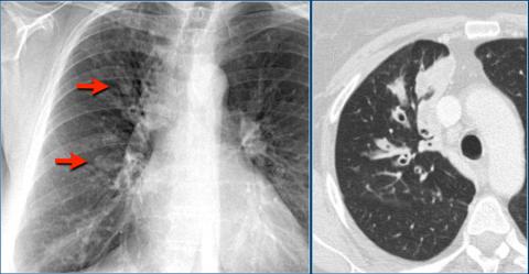 Рентгенологическая оценка лёгких: норма - Рисунок4