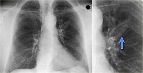 Рентгенологическая оценка лёгких: норма - Рисунок5