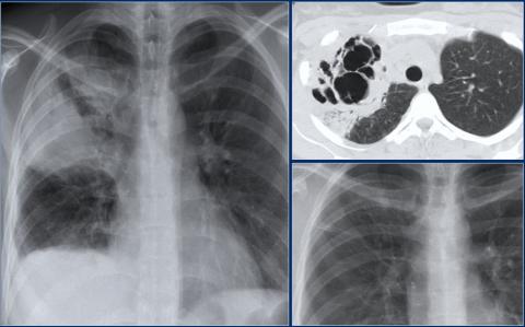 Рентгенологическая оценка лёгких: норма - Рисунок9