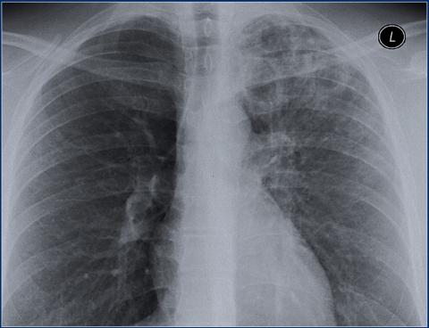 Рентгенологическая оценка лёгких: норма - Рисунок10