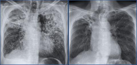 Рентгенологическая оценка лёгких: норма - Рисунок11