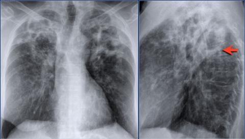 Рентгенологическая оценка лёгких: норма - Рисунок13