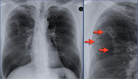 Рентгенологическая оценка лёгких: норма - Рисунок14