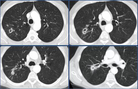 Рентгенологическая оценка лёгких: норма - Рисунок15