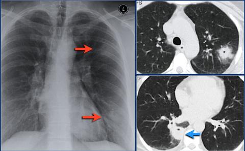 Рентгенологическая оценка лёгких: норма - Рисунок16