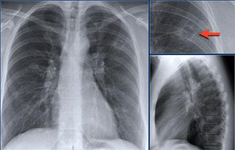 Рентгенологическая оценка лёгких: норма - Рисунок17