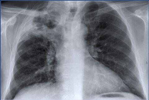 Рентгенологическая оценка лёгких: норма - Рисунок18