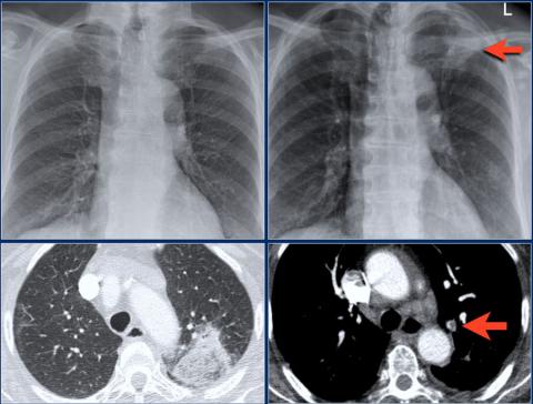 Рентгенологическая оценка лёгких: норма - Рисунок19