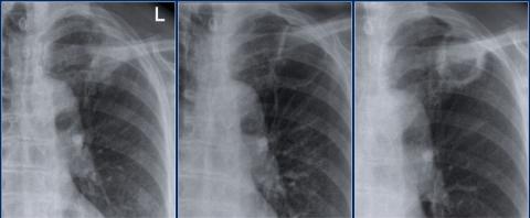 Рентгенологическая оценка лёгких: норма - Рисунок20