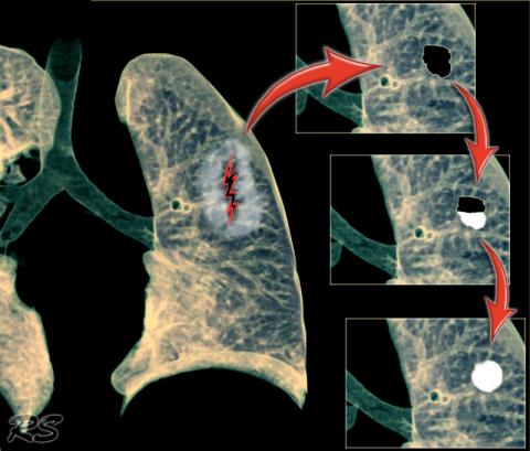 Рентгенологическая оценка лёгких: норма - Рисунок21