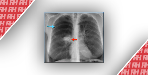 Рентгенологічна оцінка легень: норма та патологія. Частина третя - Новини RH