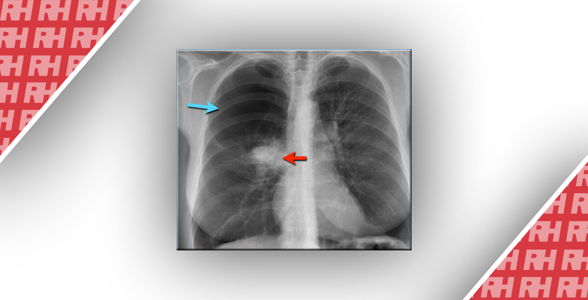 Рентгенологічна оцінка легень: норма та патологія. Частина третя - Статті RH