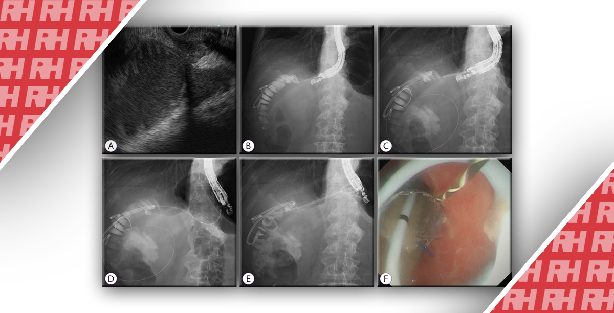 Эндоскопическая гастроэнтеростомия под ультразвуковым контролем при синдроме приводящей петли - Статьи RH