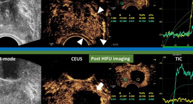 Мультипараметрична ультрасонографія (мпУЗД) для діагностики раку передміхурової залози - Статті RH