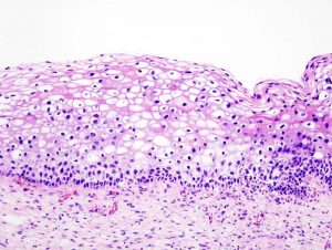 Діагностика цервікальної інтраепітеліальної неоплазії та інвазивної карциноми шийки матки за допомогою біопсії шийки матки під час кольпоскопії та аналіз факторів впливу - Новини RH