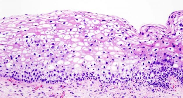 Диагностика цервикальной интраэпителиальной неоплазии и инвазивной карциномы шейки матки с помощью биопсии шейки матки во время кольпоскопии и анализ факторов влияния - Статьи RH