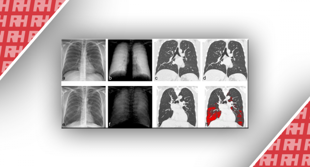 Рентгенографія органів грудної клітки в темному полі: перший досвід у пацієнтів з дефіцитом альфа-1-антитрипсину - Статті RH