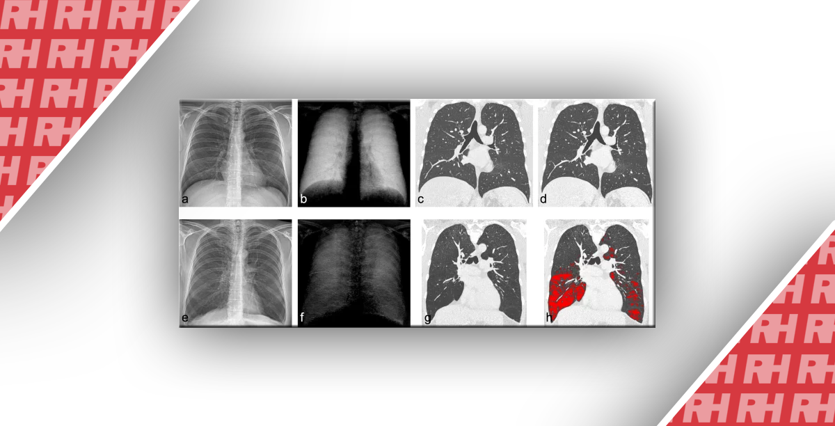 Рентгенографія органів грудної клітки в темному полі: перший досвід у пацієнтів з дефіцитом альфа-1-антитрипсину - Статті RH