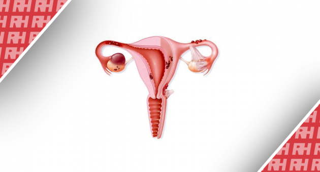 Безопасность лапароскопической хирургии в лечении эндометриоидного рака тела матки - Статьи RH