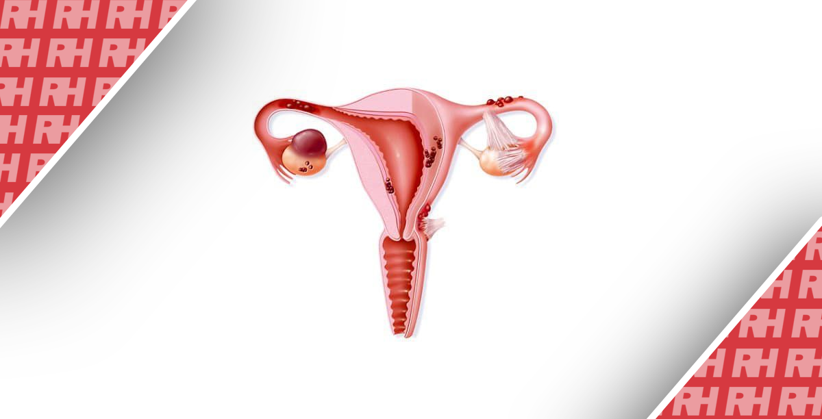 Безпечність лапароскопічної хірургії в лікуванні ендометріоїдного раку тіла матки - Статті RH