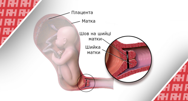Монофиламентный шов по сравнению с плетеной шовной нитью для улучшения результатов беременности после серкляжа (C-STICH): прагматическое рандомизированное, контролируемое, исследование преимуществ. Фаза 3. - Статьи RH