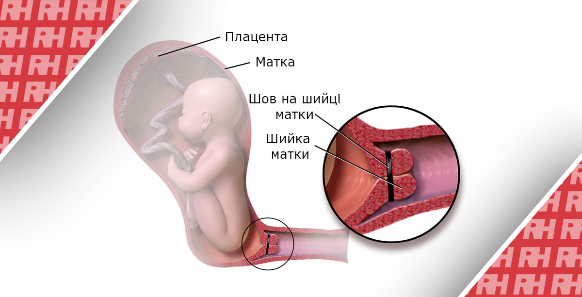 Монофиламентный шов по сравнению с плетеной шовной нитью для улучшения результатов беременности после серкляжа (C-STICH): прагматическое рандомизированное, контролируемое, исследование преимуществ. Фаза 3. - Статьи RH