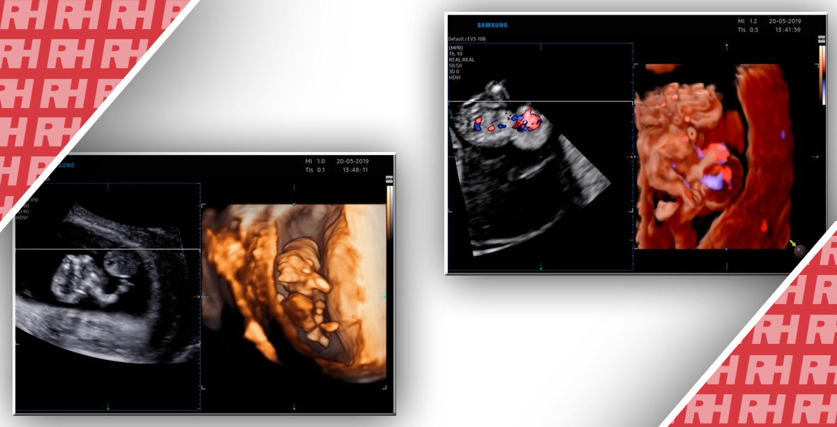 Гастрошизис, ускладнений ектопією серця: Діагностика двох випадків у першому триместрі вагітності за допомогою 2- та 3-вимірної сонографії - Новини RH