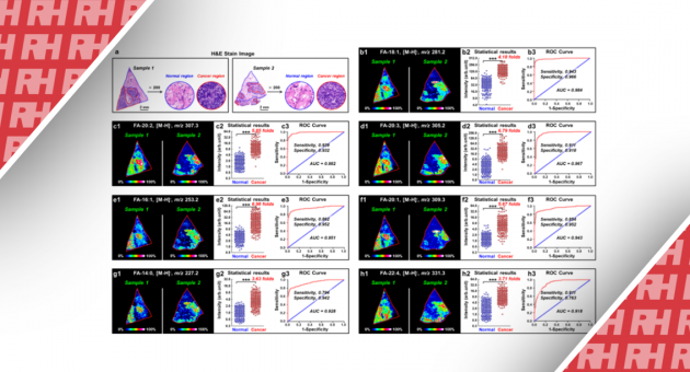 Візуалізація метаболічного перепрограмування метаболічної мережі синтезу жирних кислот відкриває нові діагностичні та терапевтичні можливості для лікування раку молочної залози - Статті RH