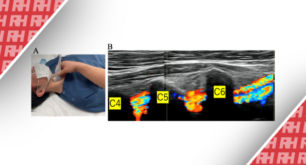 Ультрасонография является эффективным инструментом для оценки травматических повреждений позвоночной артерии дистальнее четвертого шейного позвонка в отделении неотложной помощи - Статьи RH