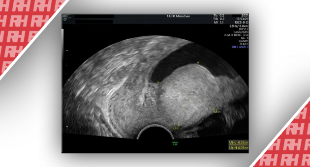 Плоскоклітинний рак ендометрія з високою мікросателітною нестабільністю при ускладненій вагітності: клінічний випадок - Статті RH