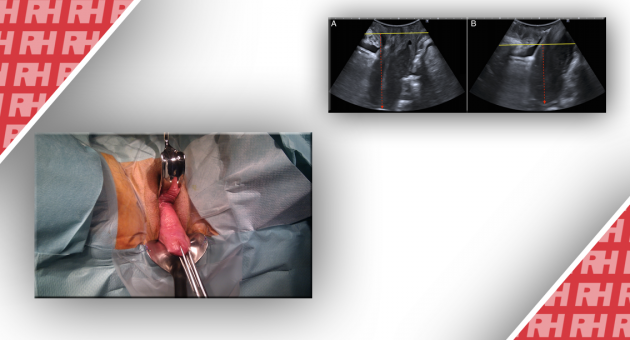 Чи можна діагностувати хірургічне опущення матки за допомогою трансперінеального ультразвуку? Багатоцентрова перевірка діагностичного програмного забезпечення - Статті RH