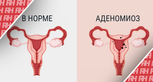 Распространенность аденомиоза у женщин с бесплодием: систематический обзор и мета-анализ - Статьи RH