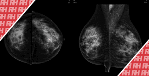 Методи покращеного виявлення підозрілих утворень молочної залози: Порівняльне дослідження повноформатної цифрової мамографії та автоматизованого ультразвукового дослідження молочної залози у 117 пацієнток з трепан біопсією - Новини RH