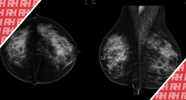 Методы улучшенного выявления подозрительных образований молочной железы: Сравнительное исследование полноформатной цифровой маммографии и автоматизированного ультразвукового исследования молочной железы у 117 пациенток с трепан биопсией - Статьи RH