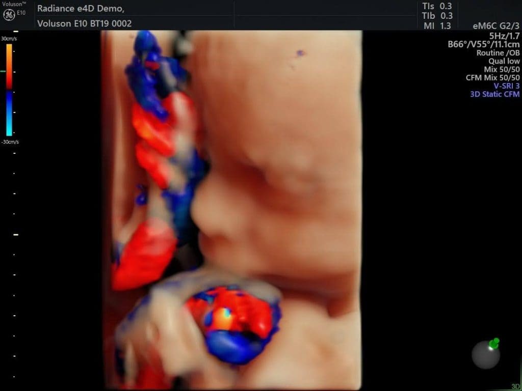 Доплерографія пупкової артерії: Посібник - Малюнок1