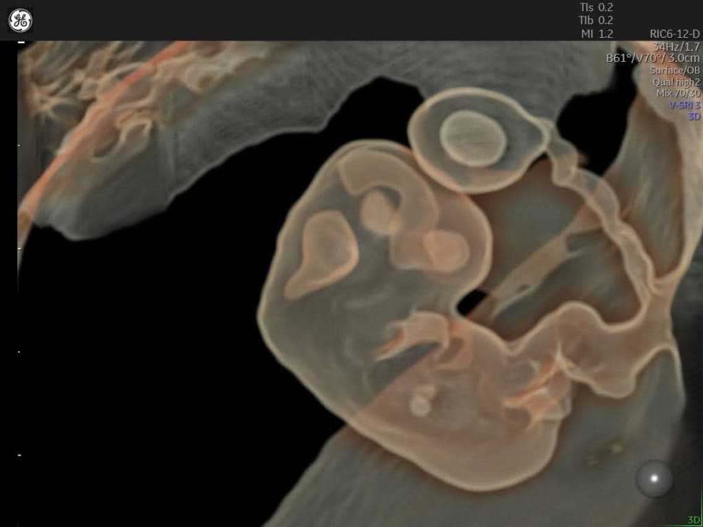 Доплерографія пупкової артерії: Посібник - Малюнок2