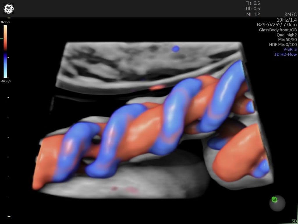 Допплерография пупочной артерии: Руководство - Рисунок4