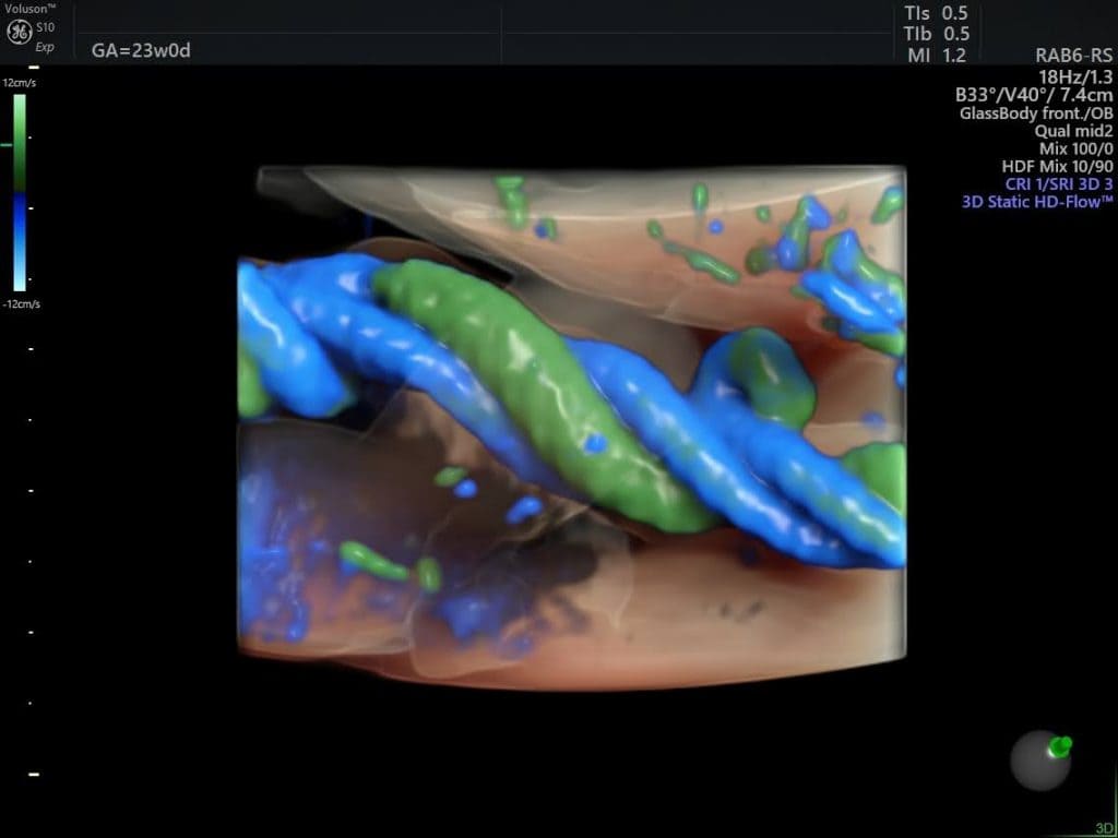 Доплерографія пупкової артерії: Посібник - Малюнок5