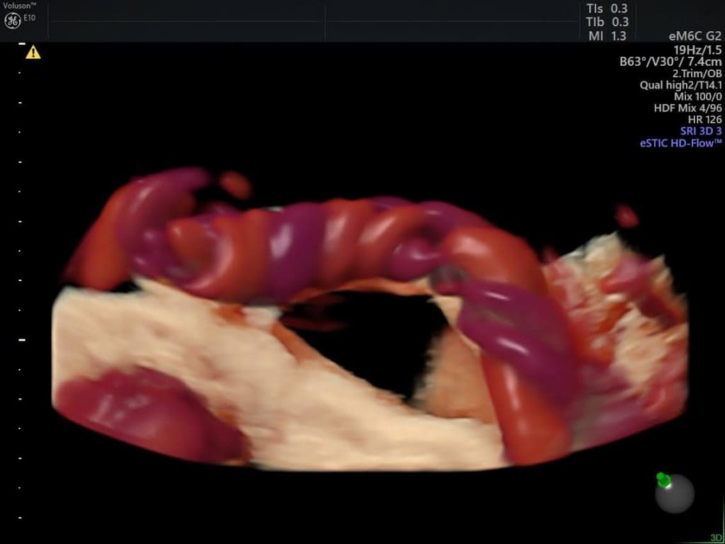 Допплерография пупочной артерии: Руководство - Рисунок7