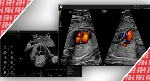 Использование ультразвука сердца плода для диагностики врожденных пороков сердца - Статьи RH