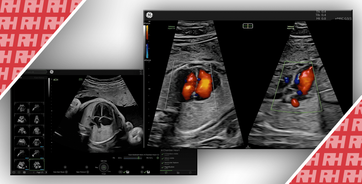 Использование ультразвука сердца плода для диагностики врожденных пороков сердца - Статьи RH