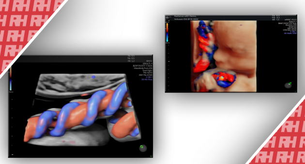 Доплерографія пупкової артерії: Посібник з проведення - Статті RH