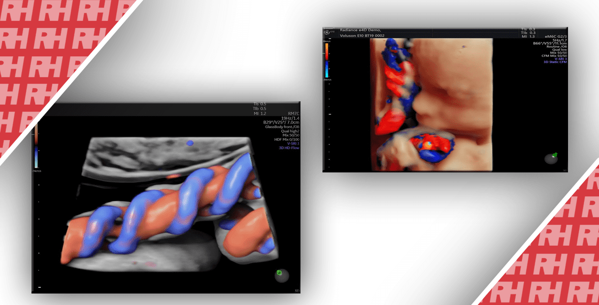 Допплерография пупочной артерии: Руководство по проведению - Статьи RH